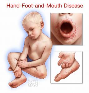 Can Kawasaki Disease Occur In Adults Can Kawasaki Disease Occur In Adults